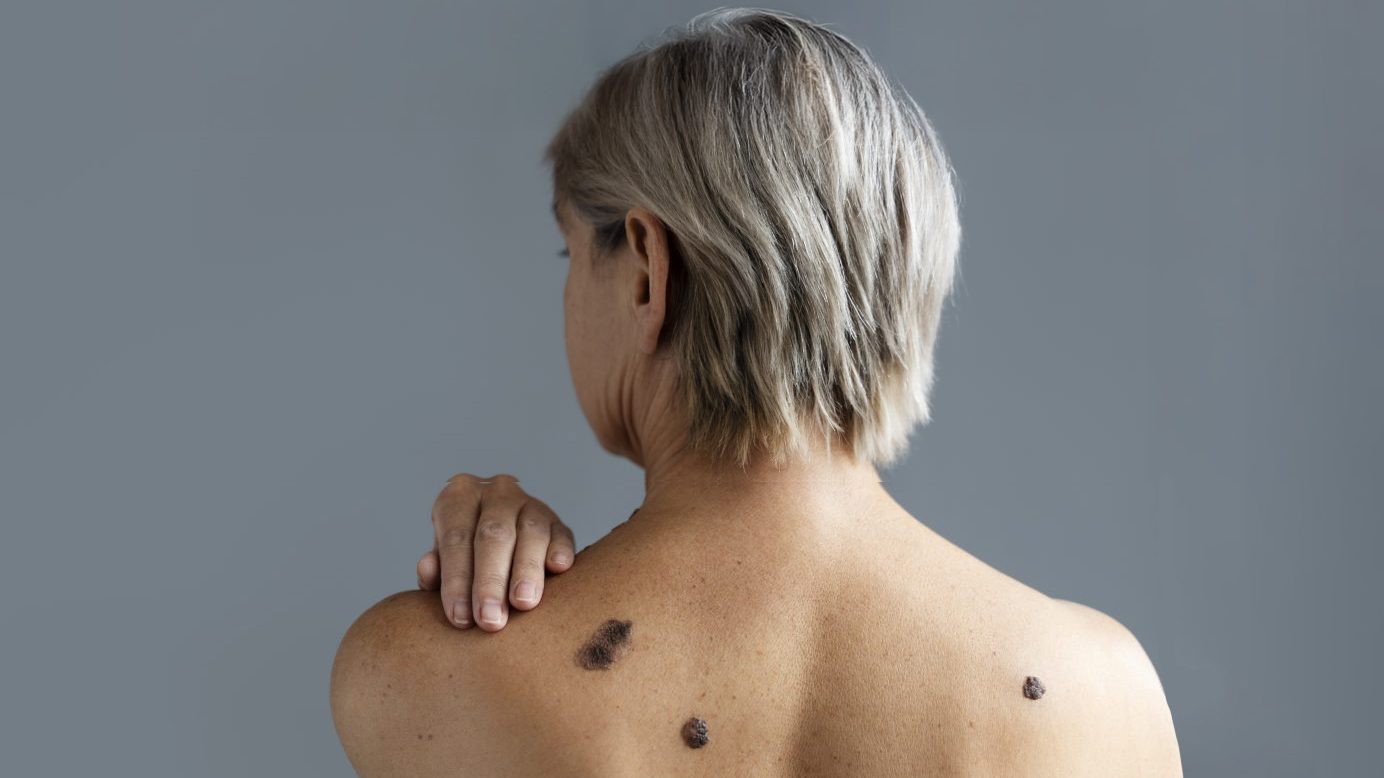 Com a aproximação do verão, intensifica-se o alerta para o câncer de pele